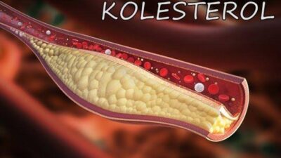 Ini Dia, Cara Menurunkan Kolestrol Tinggi Secara Alami