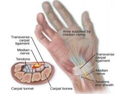Ini Dia Pengertian CTS (Carpal Tunnel Syndrome)