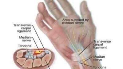 Ini Dia Pengertian CTS (Carpal Tunnel Syndrome)