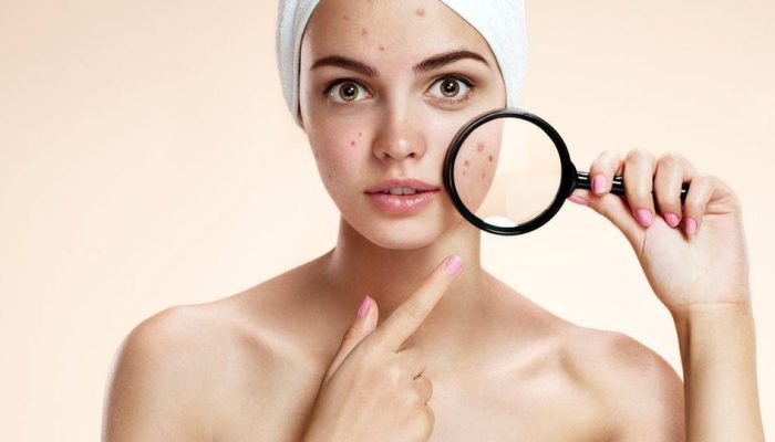 Jerawat Hormonal Mengamuk? Stop 9 Kesalahan Skincare Ini