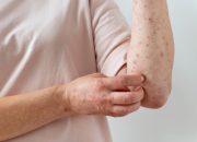 Cacar Air: Mandikan Anak atau Tidak? Kata Dokter
